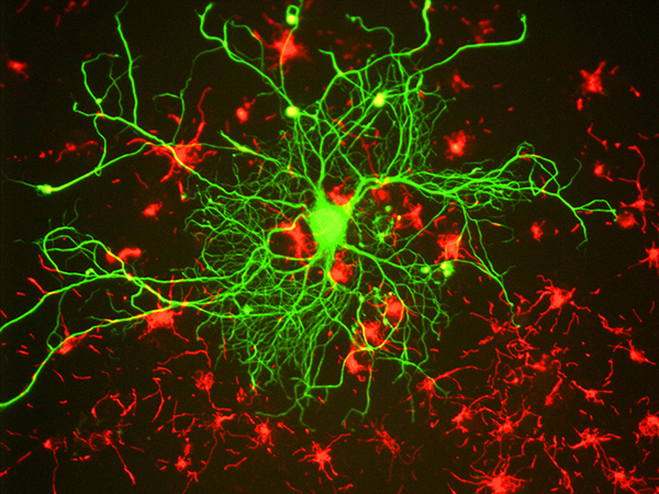 The Fight Against Alzheimer’s